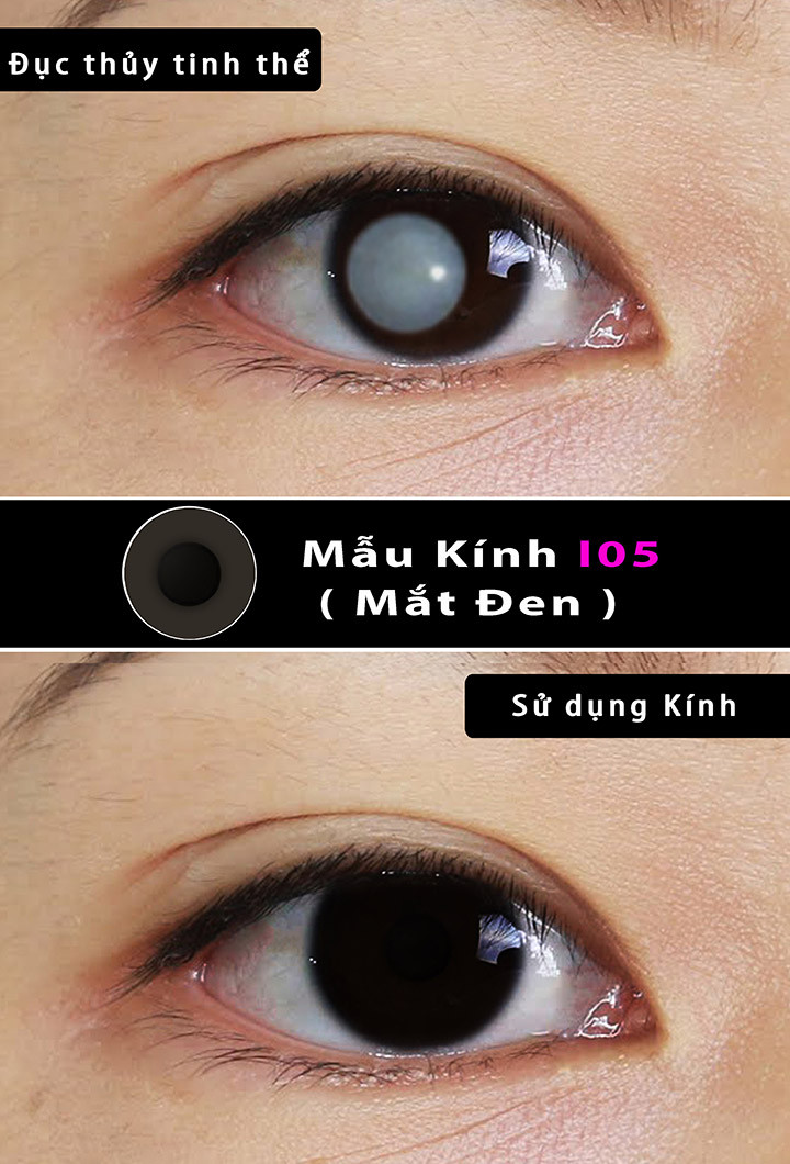 LENS CHE TẬT THỊ- MÀU ĐEN ( I05 )