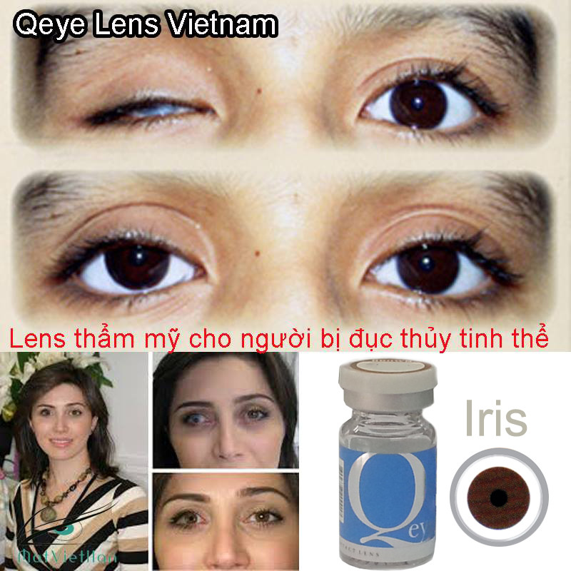 LENS THẨM MỸ- LENS CHE KHUYẾT ĐIỂM  IRIC3 - SIZE 14.2MM